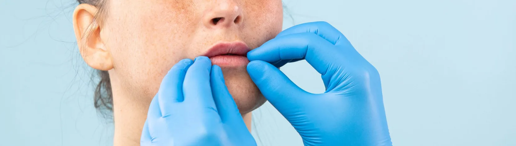 Opéra lip fillers 2