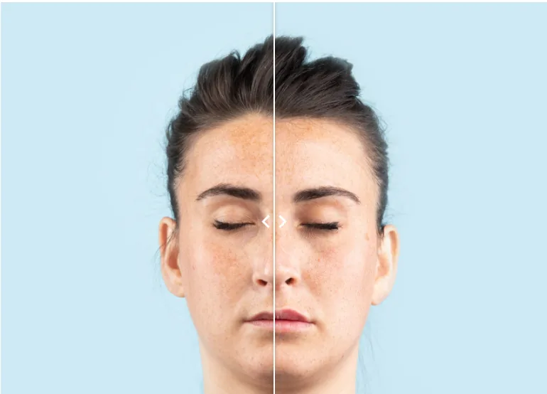 Opéra lip fillers 3